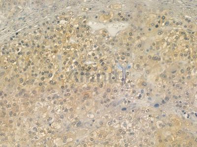 SGCG Antibody - DF12473 at 1/100 staining human hepatocellular carcinoma by IHC-P.