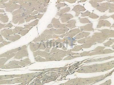 SGCG Antibody - DF12473 at 1/100 staining human tongue carcinoma by IHC-P.