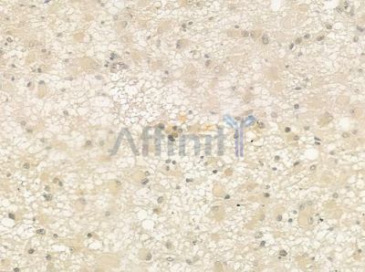 SRPX2 Antibody - DF12480 at 1/100 staining human astrocytoma by IHC-P.