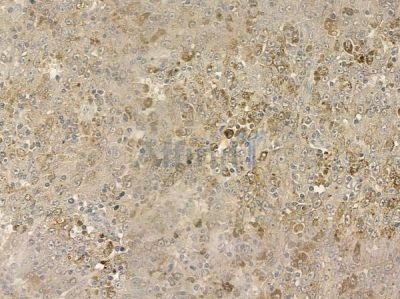 TMEM70 Antibody - DF12488 at 1/100 staining human melanoma by IHC-P.