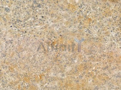 USP9X Antibody - DF12498 at 1/100 staining human hepatocellular carcinoma by IHC-P.