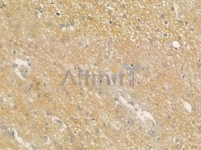 WDR1 Antibody - DF12501 at 1/100 staining human glioblastoma by IHC-P.
