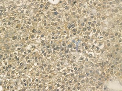 ZFYVE16 Antibody - DF12507 at 1/100 staining human hepatocellular carcinoma by IHC-P.