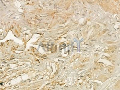 DIRAS3 Antibody - DF2200 at 1/100 staining human testicular cancer by IHC-P.