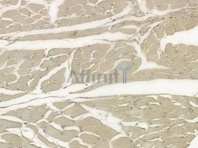 MCF2L Antibody - DF2202 at 1/100 staining human tongue carcinoma by IHC-P.