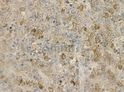 NDUFA10 Antibody - DF2211 at 1/100 staining human melanoma by IHC-P.