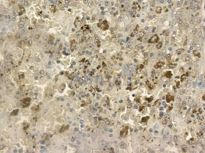CCL24 Antibody - DF2240 at 1/100 staining human melanoma by IHC-P.