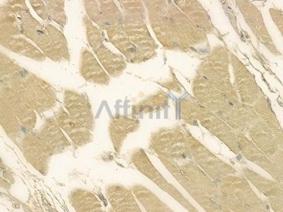 SLC34A2 Antibody - DF2244 at 1/100 staining human tongue carcinoma by IHC-P.