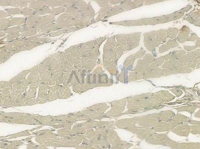 TCAP Antibody - DF2248 at 1/100 staining human tongue carcinoma by IHC-P.