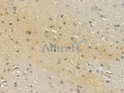 TSEN2 Antibody - DF2255 at 1/100 staining human glioblastoma by IHC-P.