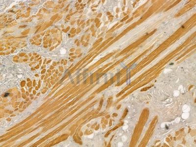 TNNT3 Antibody - DF2256 at 1/100 staining human tongue carcinoma by IHC-P.