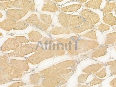 CD40L Antibody - DF2301 at 1/100 staining human tongue carcinoma by IHC-P.