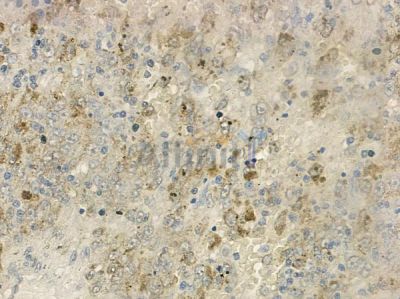 CD63 Antibody - DF2305 at 1/100 staining human melanoma by IHC-P.
