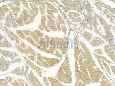 CENPR Antibody - DF2317 at 1/100 staining human tongue carcinoma by IHC-P.