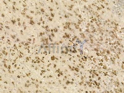 ANAPC13 Antibody - DF2371 at 1/100 staining human melanoma by IHC-P.