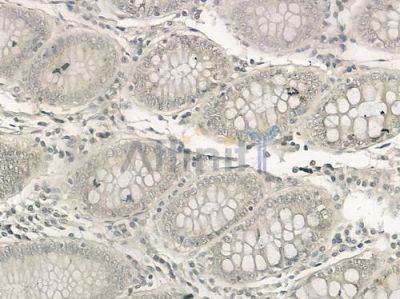 ANAPC13 Antibody - DF2371 at 1/100 staining human colon carcinoma by IHC-P.