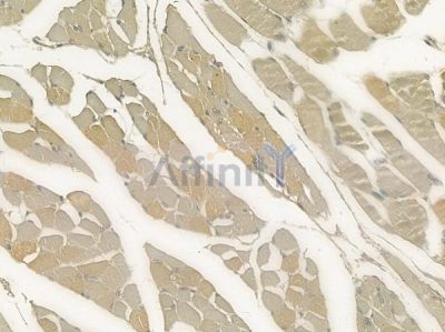 Granzyme K Antibody - DF2377 at 1/100 staining human tongue carcinoma by IHC-P.