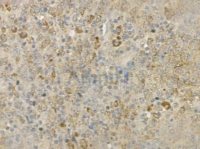 GZMM Antibody - DF2378 at 1/100 staining human melanoma by IHC-P.