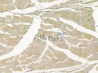 PARP4 Antibody - DF2386 at 1/100 staining human tongue carcinoma by IHC-P.