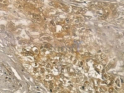 CBF-C Antibody - DF2395 at 1/100 staining human lung squamous cell carcinoma by IHC-P.