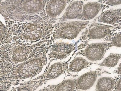 CBF-C Antibody - DF2395 at 1/100 staining human colon carcinoma by IHC-P.