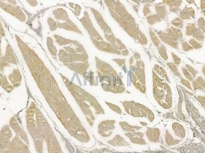 MRCKG Antibody - DF2413 at 1/100 staining human tongue carcinoma by IHC-P.