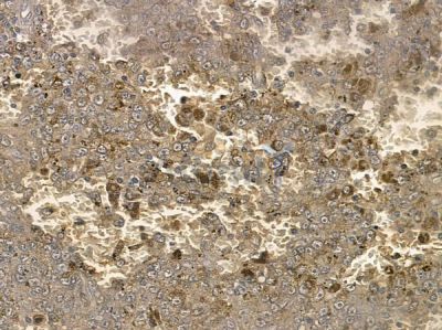 Virion infectivity factor Antibody - DF2418 at 1/100 staining human melanoma by IHC-P.
