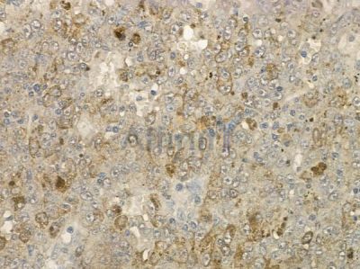 VSIG2 Antibody - DF2446 at 1/100 staining human melanoma by IHC-P.