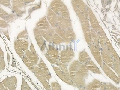 ALKBH3 Antibody - DF2449 at 1/100 staining human tongue carcinoma by IHC-P.