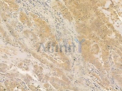 HOP Antibody - DF2456 at 1/100 staining human lung adenocarcinoma by IHC-P.