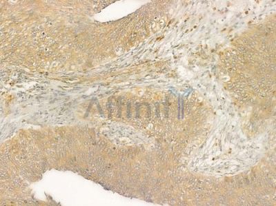 HOP Antibody - DF2456 at 1/100 staining human cervical carcinoma by IHC-P.