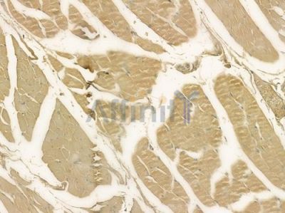 TRI31 Antibody - DF2463 at 1/100 staining human tongue carcinoma by IHC-P.
