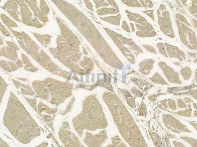 SLC35C2 Antibody - DF2473 at 1/100 staining human tongue carcinoma by IHC-P.
