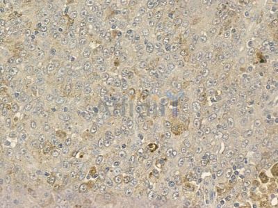 BIN2 Antibody - DF2479 at 1/100 staining human melanoma by IHC-P.