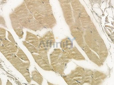 TNF18 Antibody - DF2483 at 1/100 staining human tongue carcinoma by IHC-P.