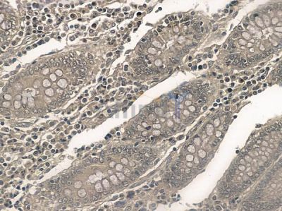 DNAJB6 Antibody - DF2489 at 1/100 staining human colon carcinoma by IHC-P.