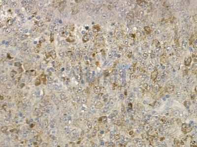 IL12RB1 Antibody - DF2508 at 1/100 staining human melanoma by IHC-P.