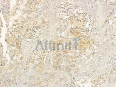 IFITM1 Antibody - DF2513 at 1/100 staining human lung squamous cell carcinoma by IHC-P.