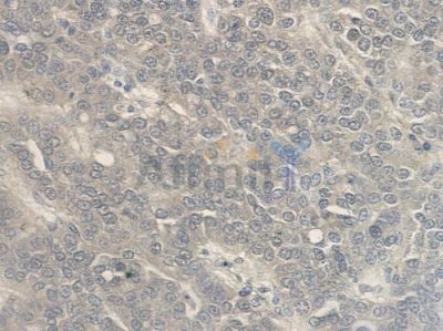 IGFL1 Antibody - DF2517 at 1/100 staining human ovarian carcinoma by IHC-P.