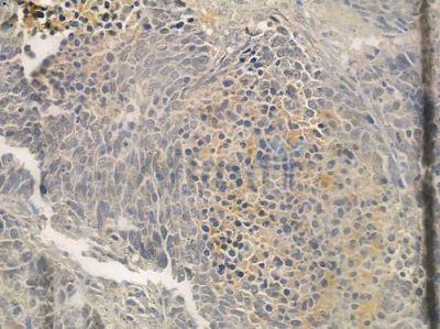 IL1F6 Antibody - DF2524 at 1/100 staining human large cell lung carcinoma by IHC-P.