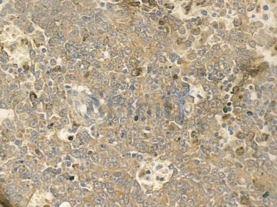 IL1F8 Antibody - DF2525 at 1/100 staining human melanoma by IHC-P.