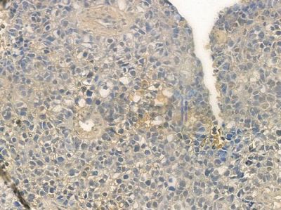 IL25 Antibody - DF2528 at 1/100 staining human glioblastoma by IHC-P.