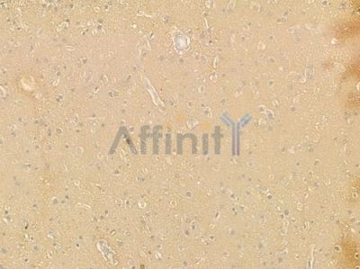 ST2 Antibody - DF2533 at 1/100 staining human astrocytoma by IHC-P.