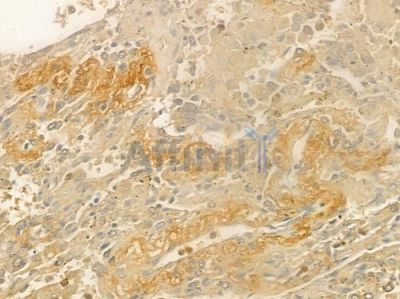 ST2 Antibody - DF2533 at 1/100 staining human lung squamous cell carcinoma by IHC-P.