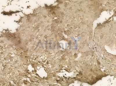 INSL6 Antibody - DF2536 at 1/100 staining human testicular cancer by IHC-P.