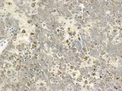 PAK1IP1 Antibody - DF2563 at 1/100 staining human melanoma by IHC-P.