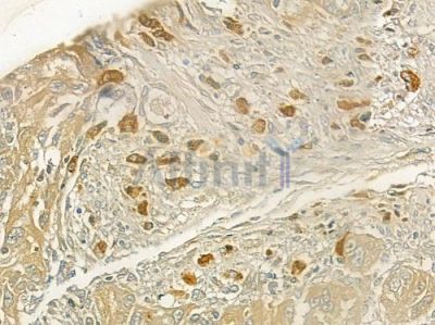 SETDB2 Antibody - DF2566 at 1/100 staining human tongue carcinoma by IHC-P.