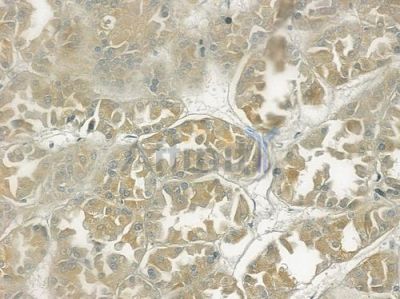 NDFIP2 Antibody - DF2596 at 1/100 staining human renal cell carcinoma by IHC-P.