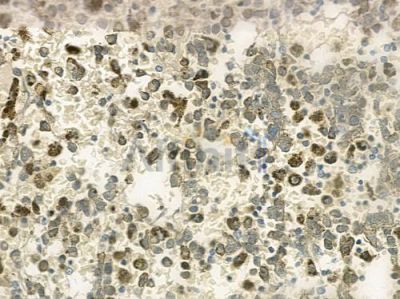 SMARCAD1 Antibody - DF2598 at 1/100 staining human melanoma by IHC-P.