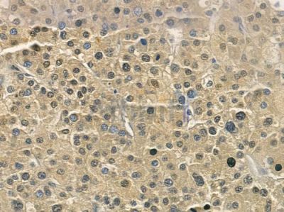 Cytochrome P450 4F12 Antibody - DF2614 at 1/100 staining human hepatocellular carcinoma by IHC-P.